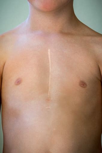 Front View Of Young Caucasian Boy With Healed Surgical Scar After Heart