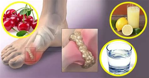 6 Natural Remedies To Remove Uric Acid Crystal Deposits In The Joints