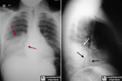 Learning Radiology Pneumonia Right Lower Lobe Rll