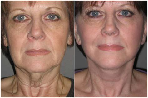 Tlc Face And Neck Lift Before And After Las Vegas And Henderson Nv The