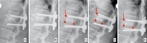 Evaluation Of Spinal Fusion In Thoracic And Thoracolumbar Spine On Standard X Rays A New