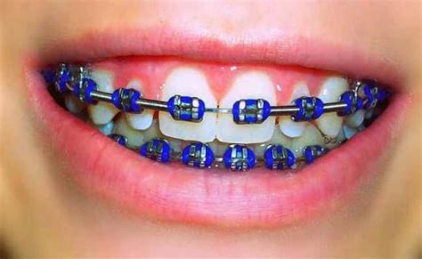 The Orthodontic Clinic Pc Colored Braces