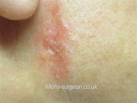 Basal Cell Carcinoma Pictures Bcc On The Neck Near To Cheek Mohs