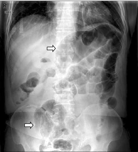 Plain Abdominal Radiographic Finding It Showed Multiple Linear