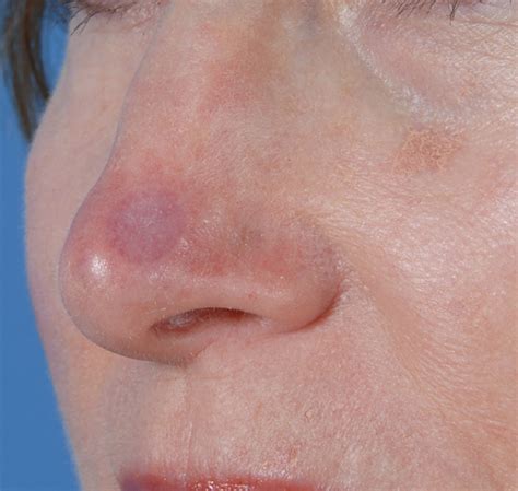 Skin Cancer On Nose Tip