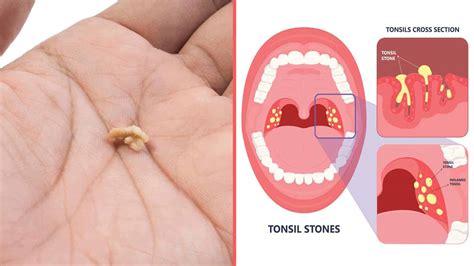 therabreath tonsil stones online shop save 51 jlcatj gob mx