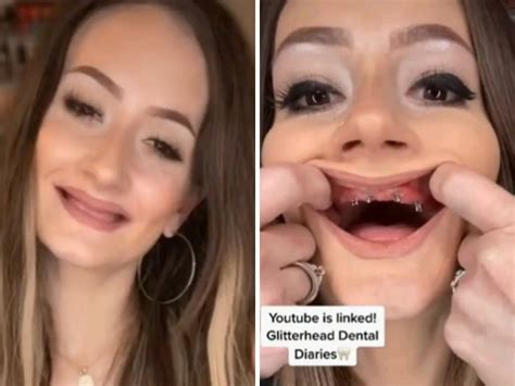 Woman Shows Off Dentureless Smile Woman Who Suffered Tooth Loss