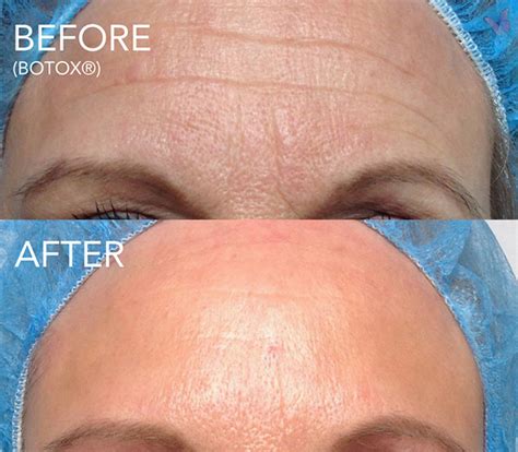 Botox Cosmetic For Fine Lines And Wrinkles Derma Health Institute