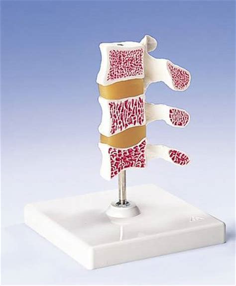 Osteoporosis Anatomy Model