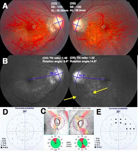 The More Myopic Eye Had Greater Optic Disc Rotation And Glaucomatous