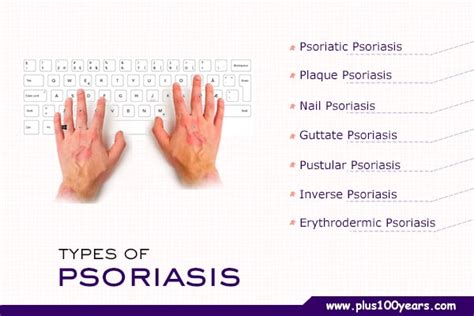 What Is Psoriasisknow The Latest Natural Remedies For Psoriasis