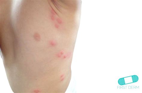 Online Dermatology Hives Urticaria