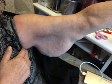 Crowdfunding To Fund My Mums Excess Arm Fat Removal On Justgiving
