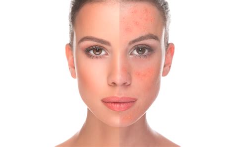 How To Use Apple Cider Vinegar To Treat Rosacea Home Remedies For