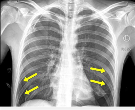 Chest X Ray Lateral View Showing Pneumothorax Download Scientific Vrogue