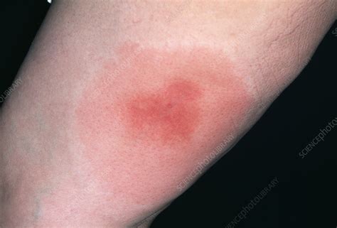 infected bee sting stock image m320 0351 science photo library