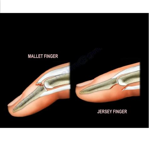 Mallet Finger Mechanism Of Injury And Treatment