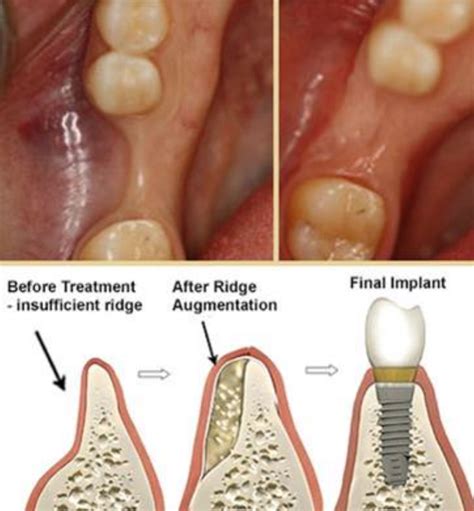 Bone Grafting For Dental Implant French Dental Services Dubai Dr