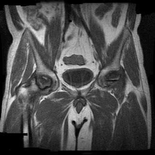 Avascular Necrosis Of The Hip Sumer S Radiology Blog