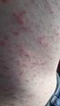 Is Skin Rash A Covid Symptom | Allergy Differences