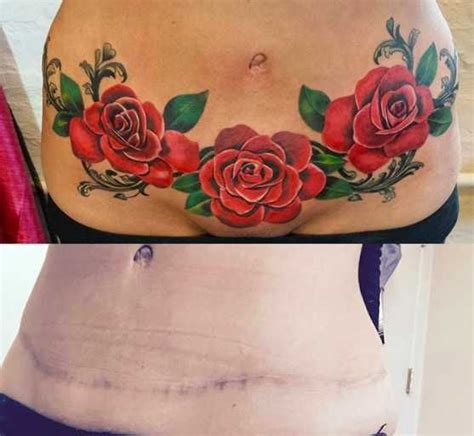 Before And After Photos Of A Woman S Stomach With Tattoos On Her Belly Showing The Results