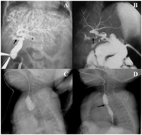 Cholangiography Via Punctured Gallbladder And Esophageal Contrast