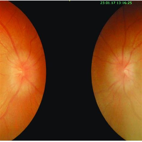 Fundus Examination Showed Resolution Of Bilateral Optic Disc Swelling
