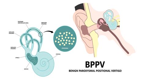What Is Bppv Or Crystals In The Inner Ear — 3d Physiotherapy Health
