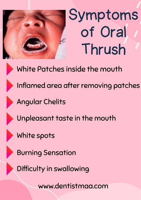 Oral Thrush Oral Candidiasis Proven Facts Dentistmaa