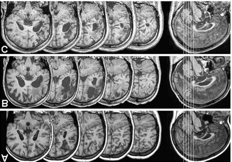 Normalized T1 Weighted Mri Scans From Three Right Hemisphere Patients