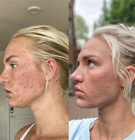 My Experience On Accutane