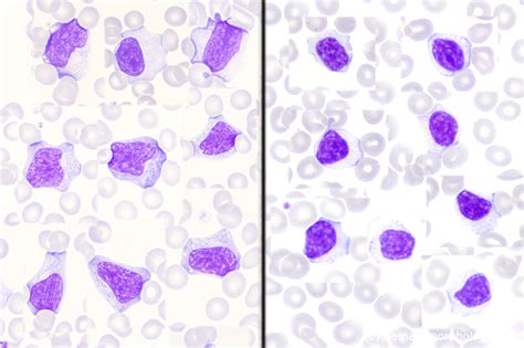 Nk Cell Large Granular Lymphocyic Leukemia Nk Lgl Chronic Nk Cell