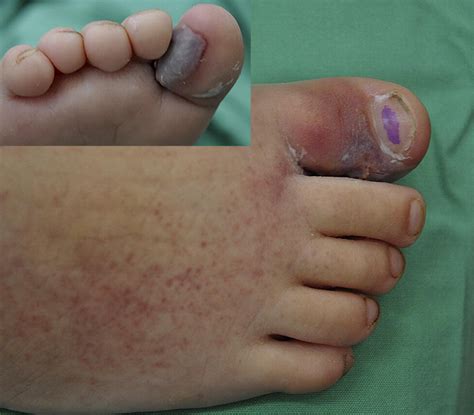 Severe Thrombocytopenia And Dermonecrosis After Loxosceles Spider Bite