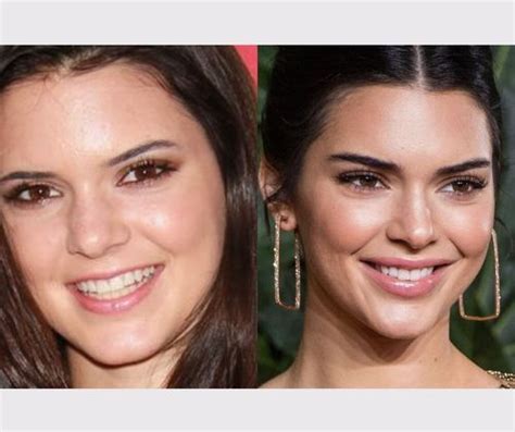 Revealed Kendall Jenner Plastic Surgery Secrets Before And After