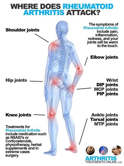 Rheumatoid Arthritis Nursing Care Plans Psoriasisarthritis