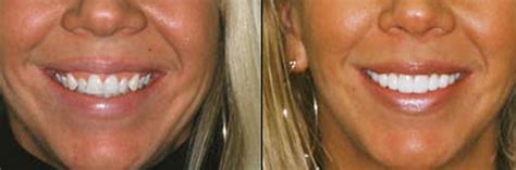 Learn more how much are lumineers below. How Much do Veneers Cost - Blog