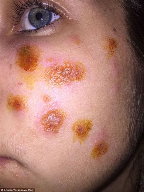 Woman Left With Severe Blisters From Botched Chemical Peel Daily Mail