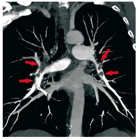 Annual Spiral Computed Tomography Ct Screening Can