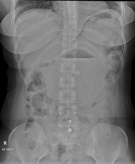 Anterior Posterior Erect Abdominal Radiograph Showing A Large Balloon Download Scientific