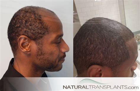 Fue Hair Transplant Before And After In Get A Great Hair