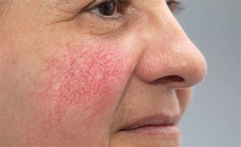 Medical Treatments And Alternative Home Remedies For Broken Capillaries