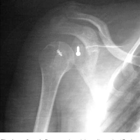 Pdf Neglected Anterior Shoulder Dislocation Open Remplissage Of The