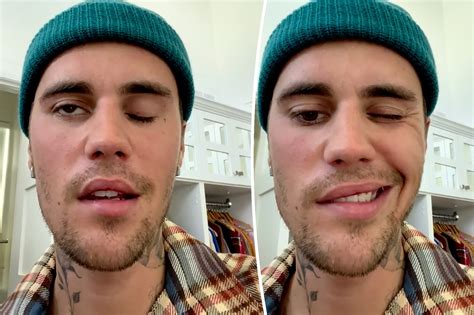 Justin Bieber S Face Paralyzed After Being Diagnosed With Rare Diso