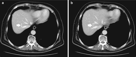 Combined Vascular Resections Abdominal Key