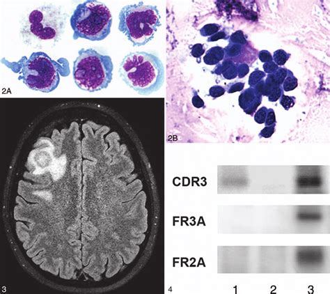 Cytology A Large And Atypical Lymphoid Cells With Large Nuclei