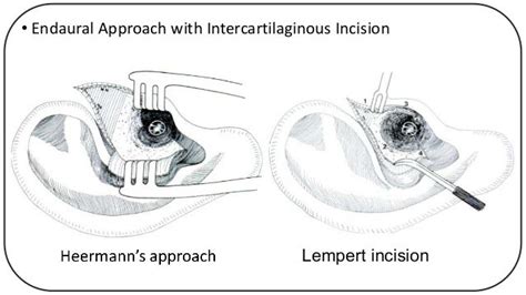 Technique Of Harvesting Cartilage Graft For Cartilage Tympanoplasty