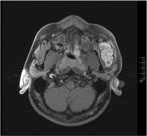 Aneurysmal Bone Cyst Of The Zygomatic Arch A Case Report Clinical