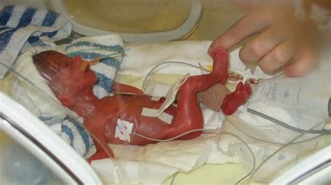 Premature Babies At 24 Weeks When Do Babies Become ‘viable Gold