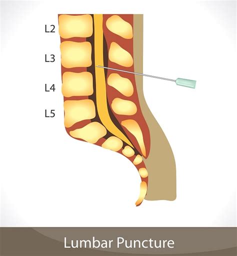 Cauda Equina Syndrome After A Lumbar Puncture Ces Attorney Lisa Levine