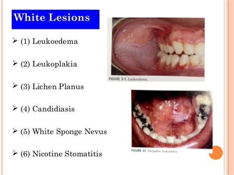 White Lesions 2